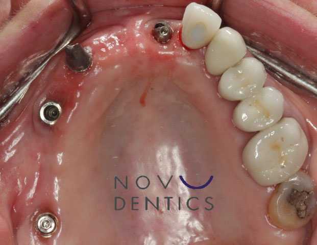 dental implant restoration procedure