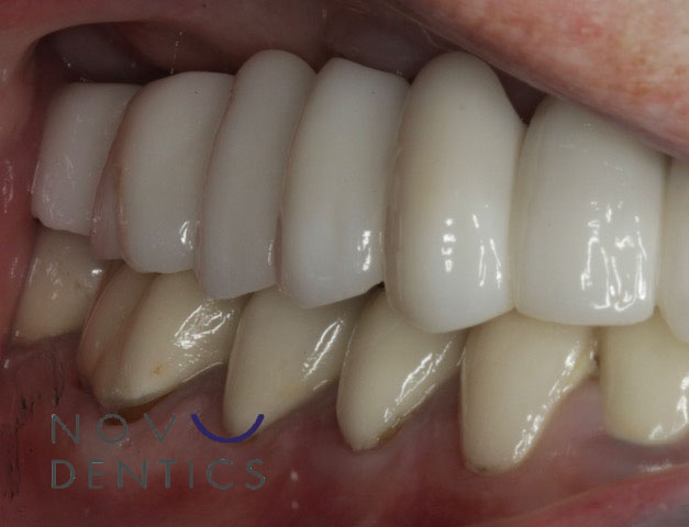 restored implants in mouth