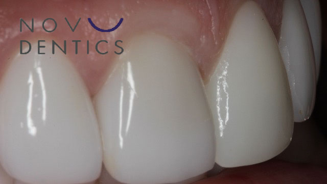 bullemia-teeth-stains-removed