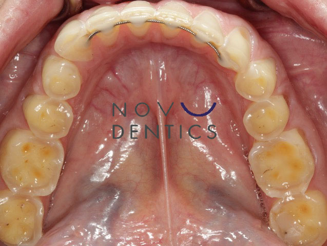 teeth-restoration-from-bullemia