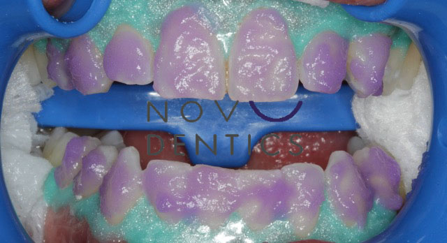 teeth-whitening-procedure-2