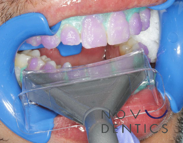 teeth-whitening-procedure-3