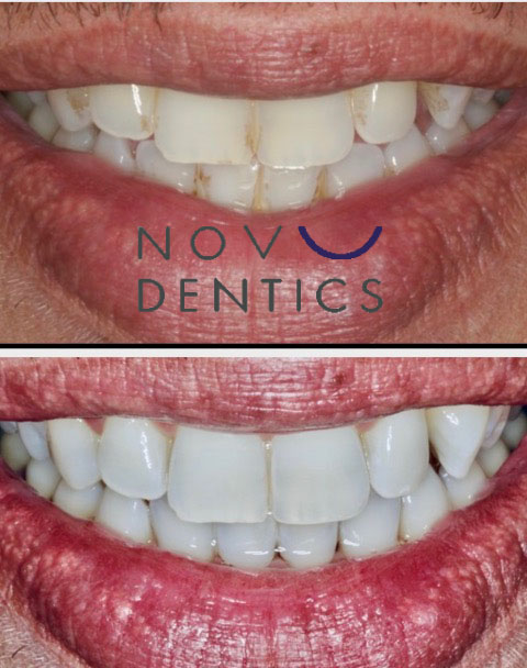 teeth-whitening-procedure-4