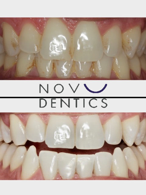 teeth-whitening-procedure-5