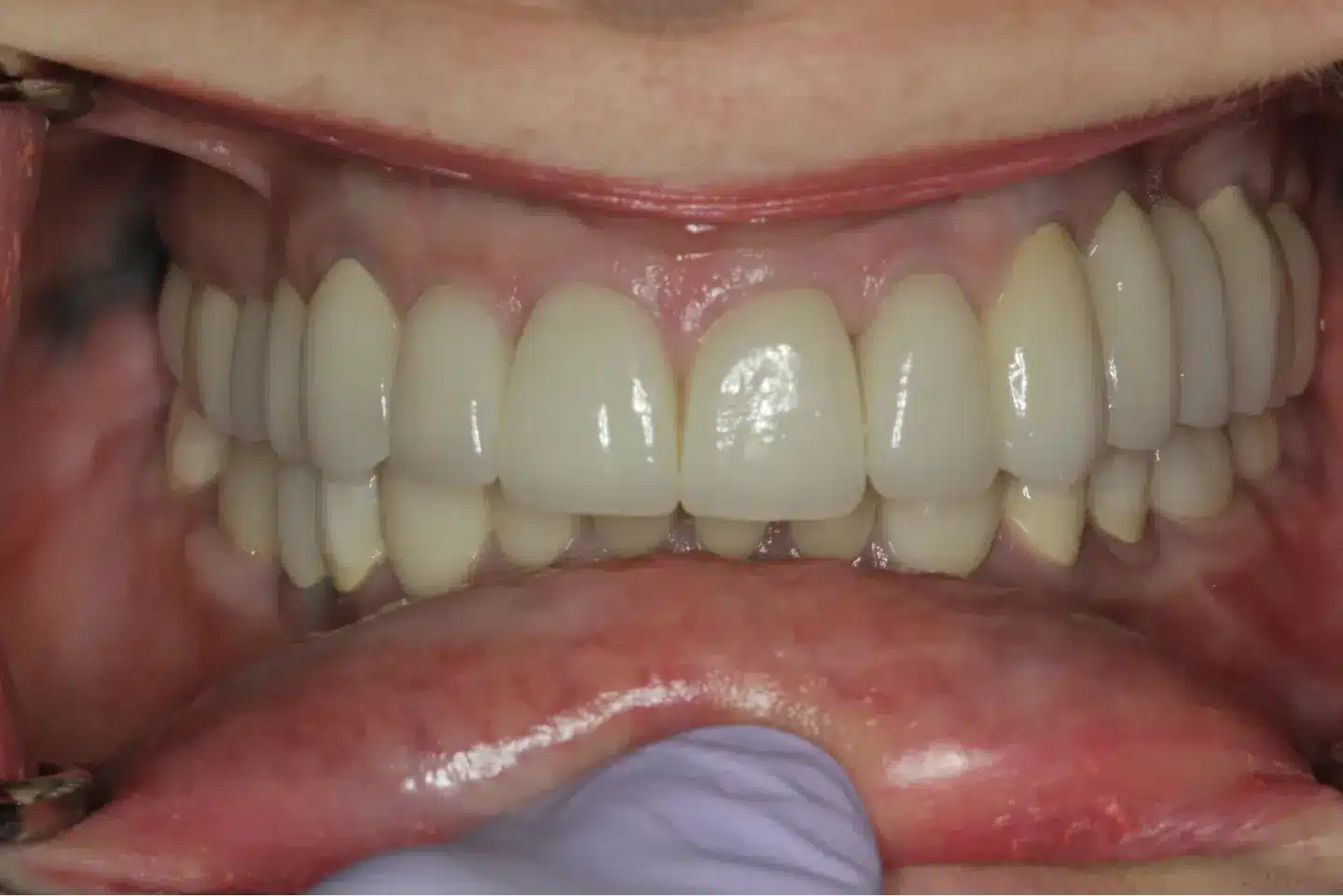 After smile makeover at Novudentics