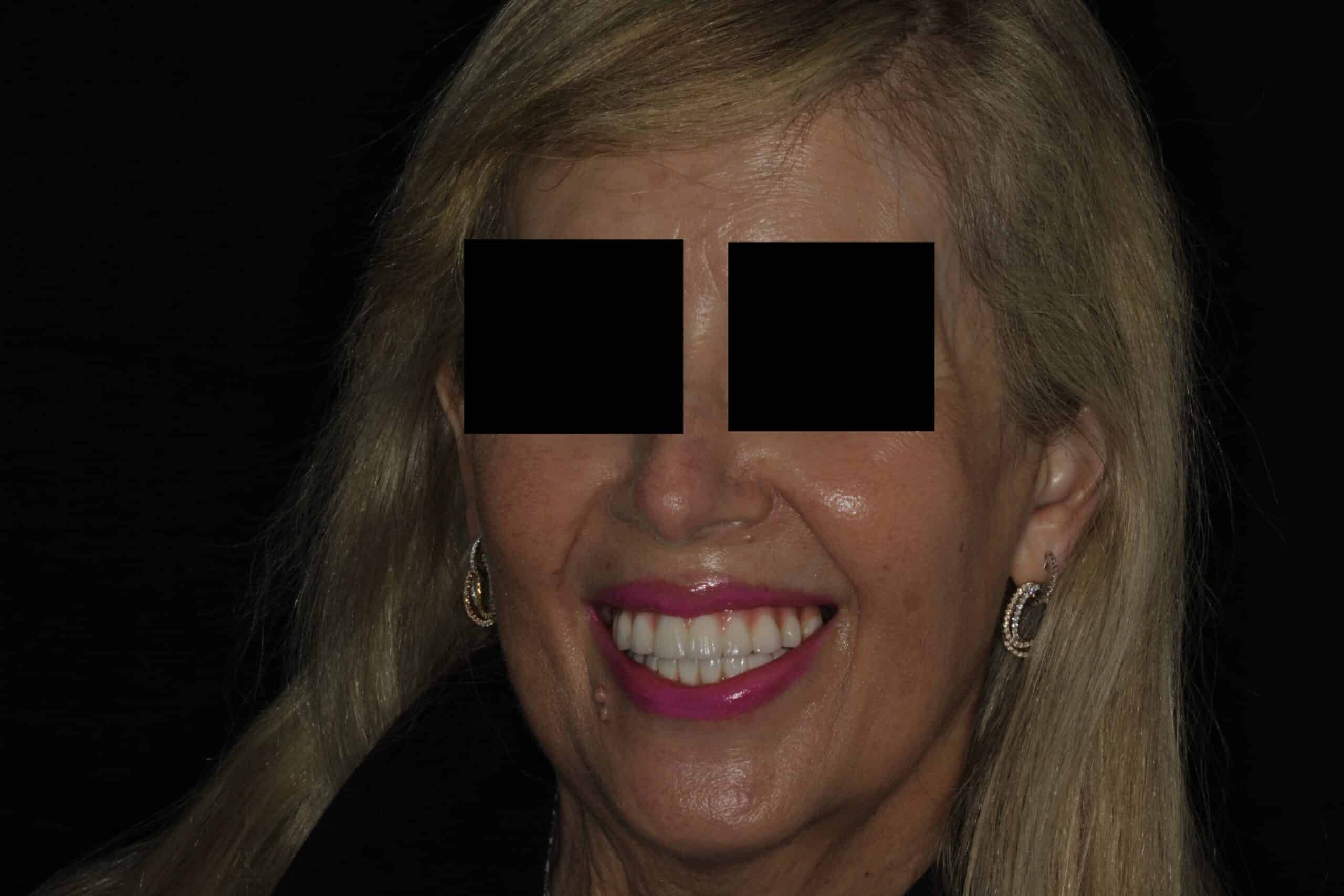 After full arch dental implants with hybrid prosthesis at Novudentics