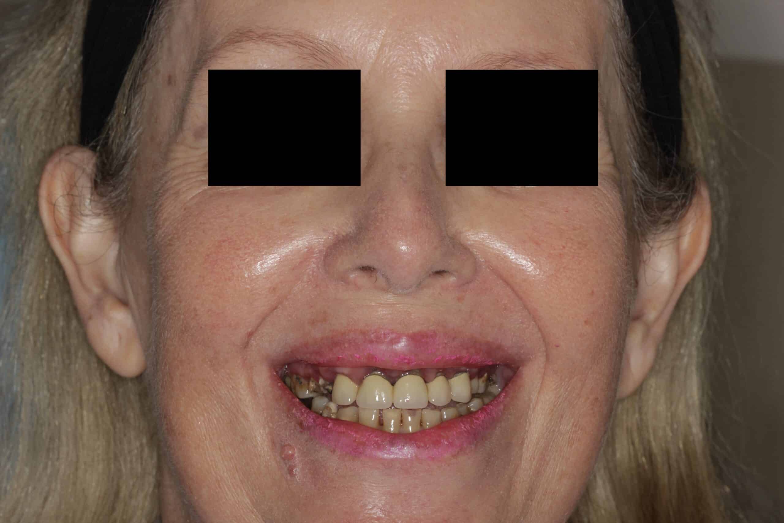 Before full arch dental implants at Novudentics Palm Beach