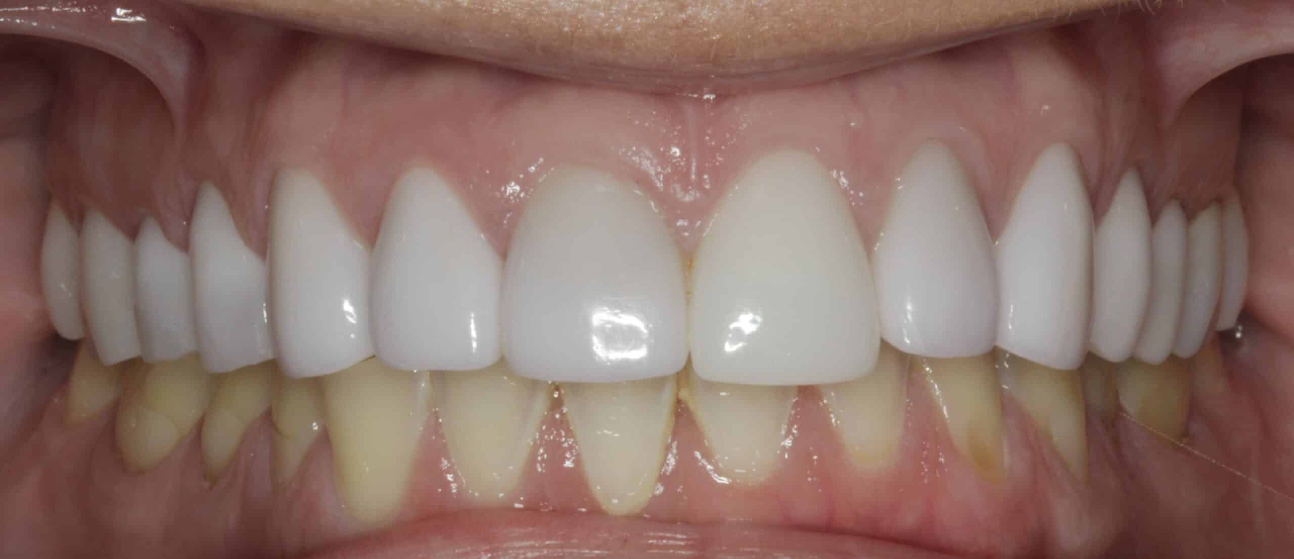 Before acid erosion rehabilitation at Novudentics