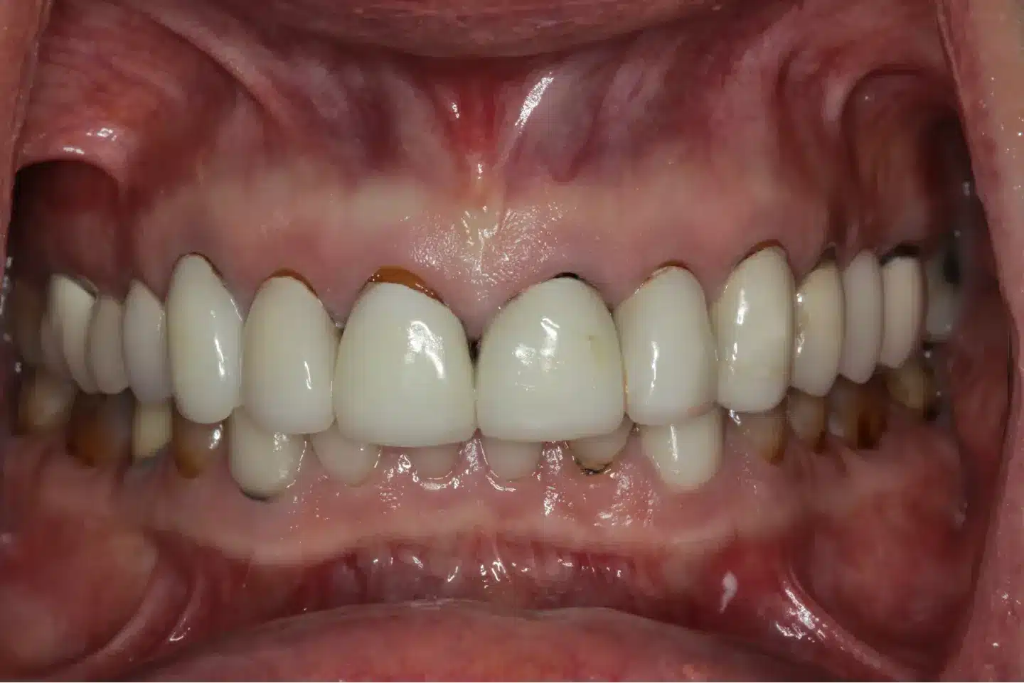 Before smile makeover at Novudentics