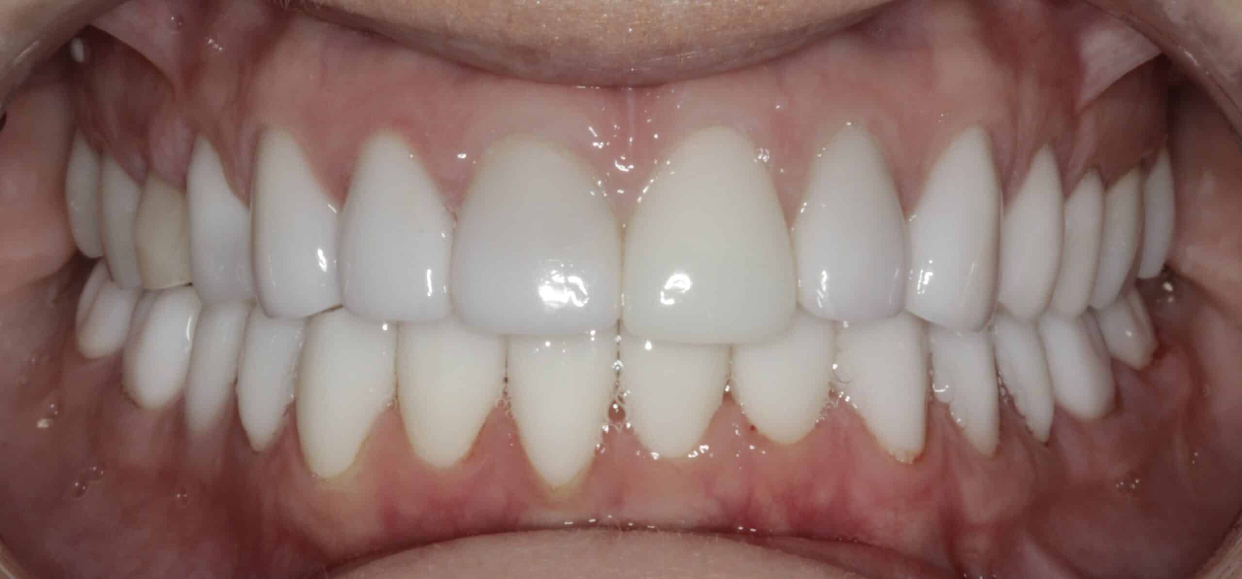 After acid erosion rehabilitation at Novudentics