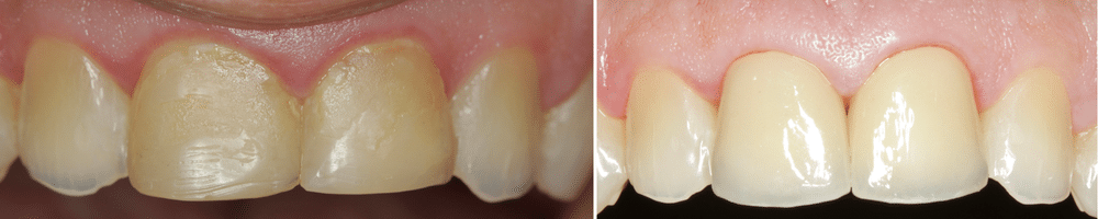 Cosmetic dentistry before and after front crowns in Royal Palm Beach at Novudentics