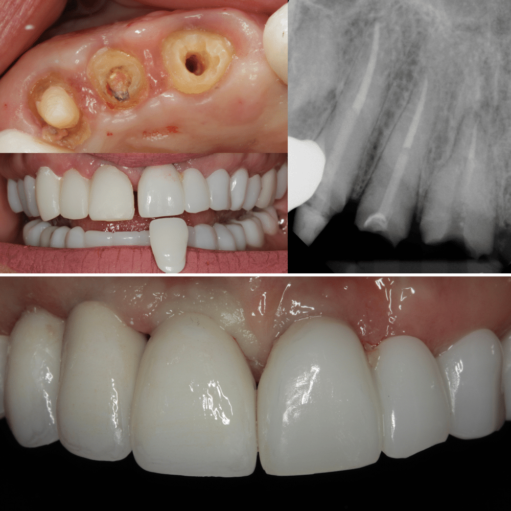 Emergency dentist and dental implants in Palm Beach FL at Novudentics