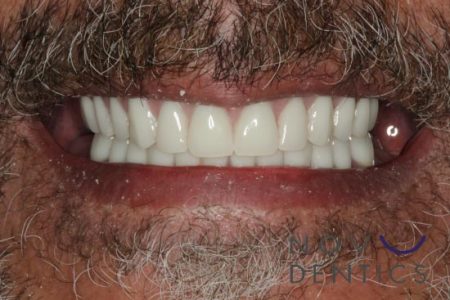 all on four after photo