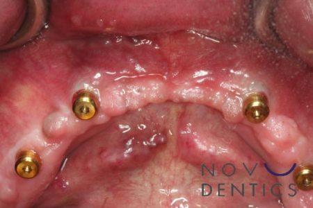 all on four dental surgery