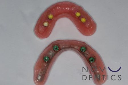 dental molds